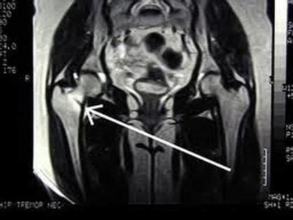 Stress Fracture - FIT AS A PHYSIO | MOSMAN