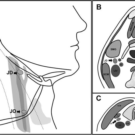 (PDF) Sonographic evaluation of jugulodigastric and juguloomohyoid ...