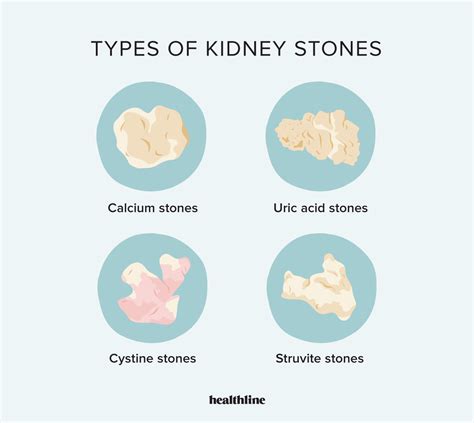 Types Of Kidney Stones Chart Comparison And Treatment – NBKomputer