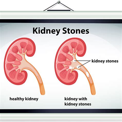 Types of Kidney Stones | How to Prevent Kidney Stones | Urogynecology