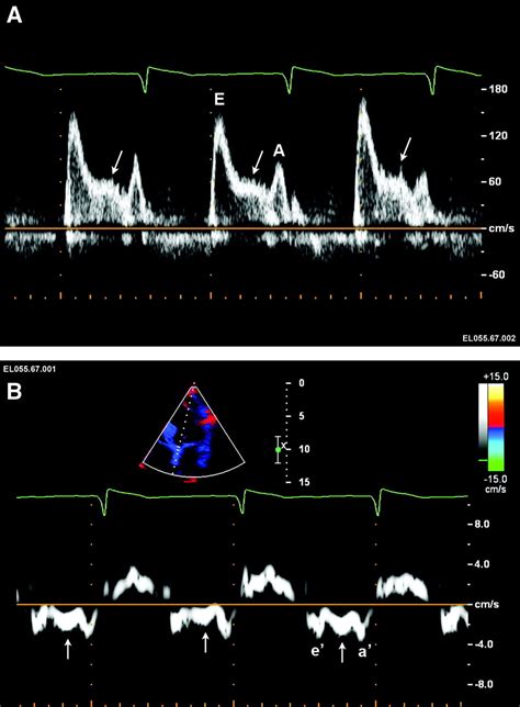 Established and Novel Clinical Applications of Diastolic Function ...