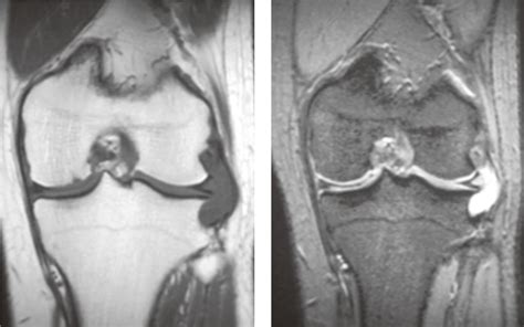 Meniscal cyst & parameniscal cyst causes, symptoms, diagnosis & treatment