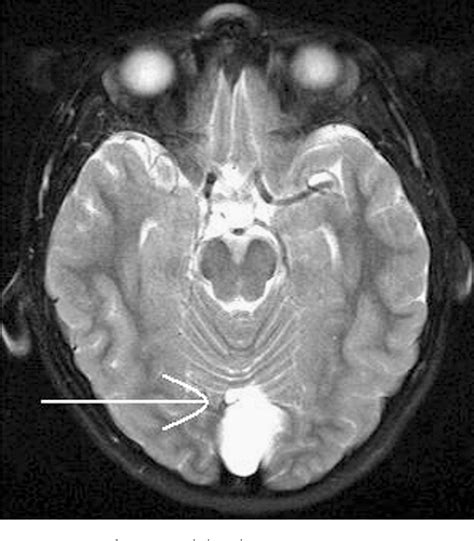 Figure 1 from Aripiprazole treatment of psychosis in a child with ...