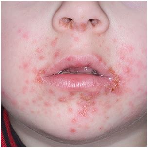 Staph Infection: Causes, Symptoms, And Identifiable Risk Factors