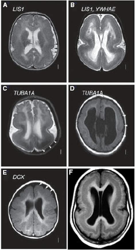 Lissencephaly Mri