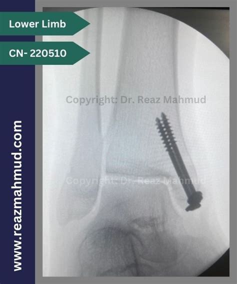 Bimalleolar Ankle Fracture | ORIF [CN-220510] - Dr. Reaz Mahmud