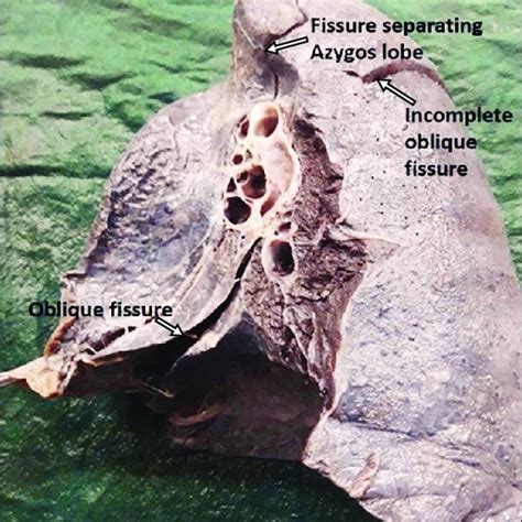 Medial surface of right lung showing incomplete oblique fissure and ...