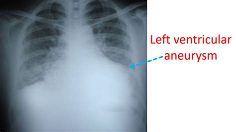 What is left ventricular aneurysm? – All About Heart And Blood Vessels