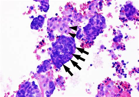 Cytology test of bloody pleural fluid. Cell block (haematoxylin-eosin ...