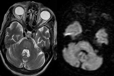 Dr Balaji Anvekar FRCR: Central Pontine Myelinolysis