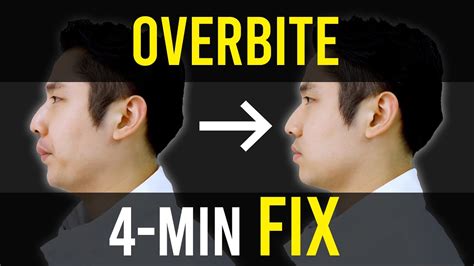 Overbite & Overjet Fix｜Facial Asymmetry Correction｜Corrective Exercises ...