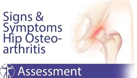 Hip Osteoarthritis Diagnosis | Signs & Symptoms of Hip OA