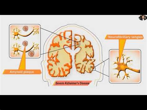 Neurofibrillary Tangles