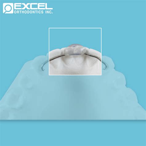 Lingual Retainer Options - Excel Orthodontics