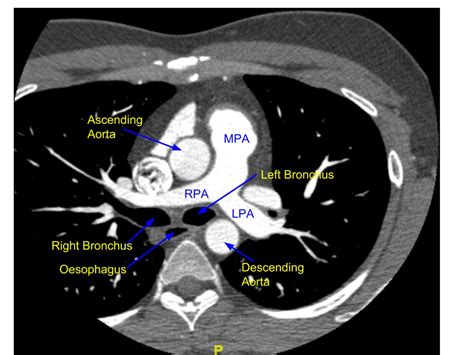 Cardiac CT – Pulmonary artery bifurcation – All About Cardiovascular ...