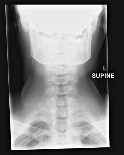 Differential Diagnosis of CSF Shunt Complications