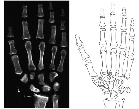 left hand, anatomy drawing by Alice Roberts | Anatomy drawing, Anatomy ...