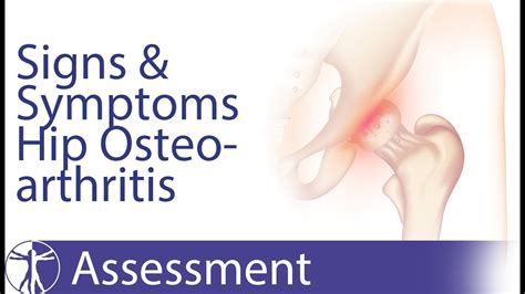 What'S The Symptoms Of Osteoarthritis? Best 16 Answer ...