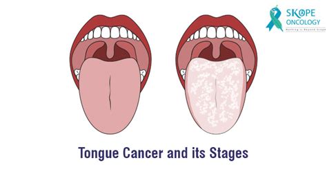 Tongue Cancer and its Stages