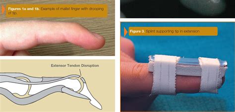 Mallet Finger (Baseball Finger) | Wrist injury, Therapy, Physical therapy