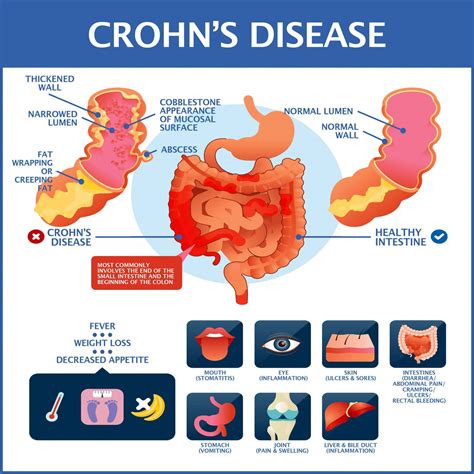 Been Diagnosed With Crohn’s Disease? | Gastroenterology of Greater Orlando