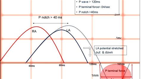 Left atrial enlargement