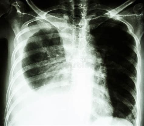 Pleural Effusion Due To Lung Cancer Royalty Free Stock Photos - Image ...