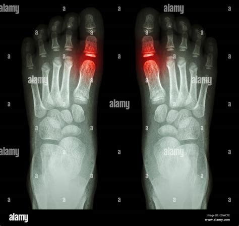 "Rheumatoid arthritis , Gouty arthritis" X-ray child's foots and Stock ...