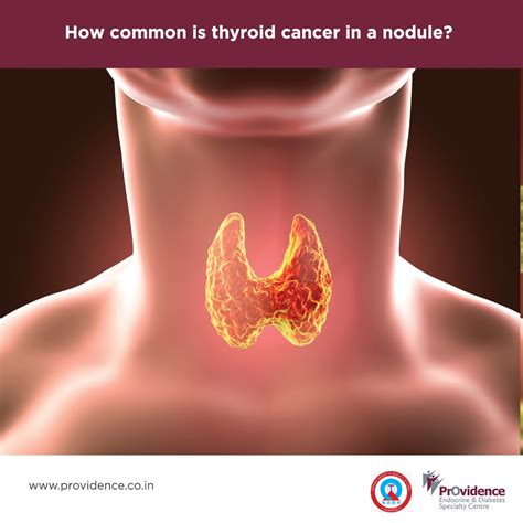 How Common is Thyroid Cancer in a Nodule? | Providence Specialty Centre