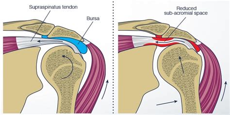 Shoulder Impingement Syndrome Treatment