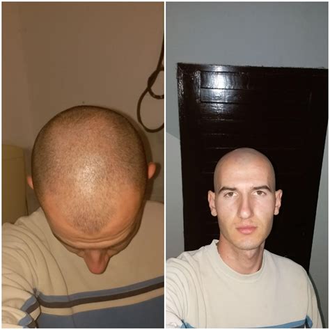 (20y)I am forced to shave head every 2 or 3 days,my baldness is ...