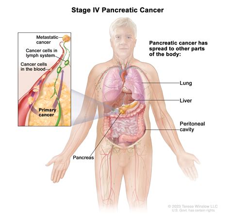 Pancreatic Cancer | UCSF Department of Surgery