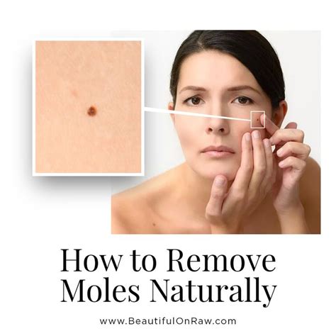 Skin Moles … Removal and Prevention | Beautiful on Raw | Skin moles ...