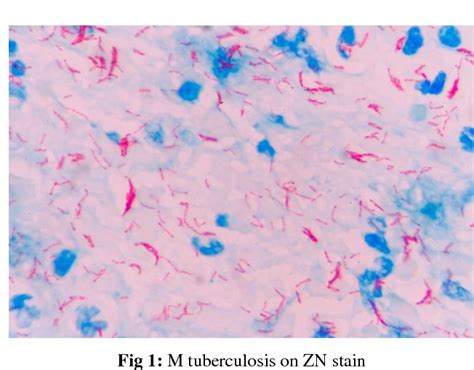 Detection of Mycobacterium tuberculosis with conventional microscopic ...