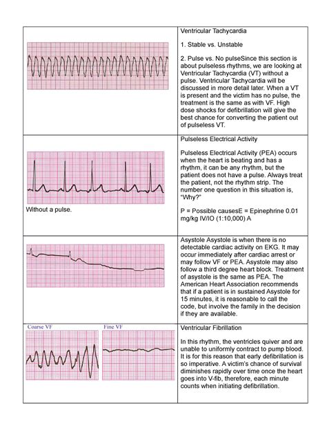 Palsacls - blah - Ventricular Tachycardia Stable vs. Unstable Pulse vs ...