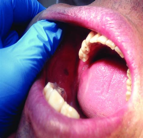 Melanotic macule detected in the buccal mucosa of the patient who ...