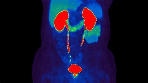 First PET Scan using new tracer for prostate cancer diagnosis - Centre ...