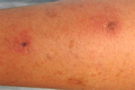 How do leg ulcers start pictures | Symptoms and pictures