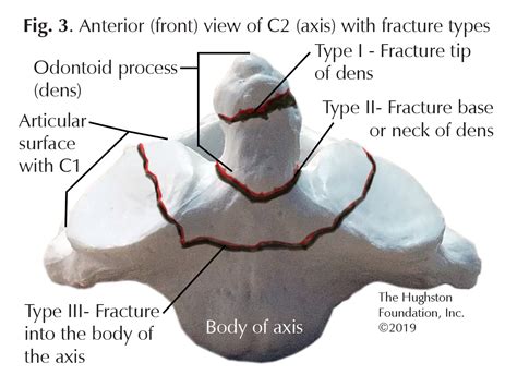 Odontoid Fractures - Hughston Clinic