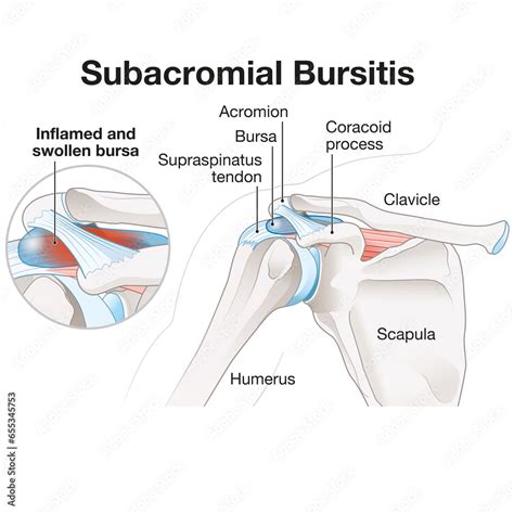 Subacromial bursitis of the shoulder. Medically Illustration. Labeled ...