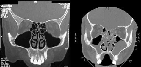 Sinus Surgery | GNO Snoring & Sinus