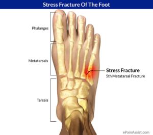 What is a hairline fracture? - Podiatry First