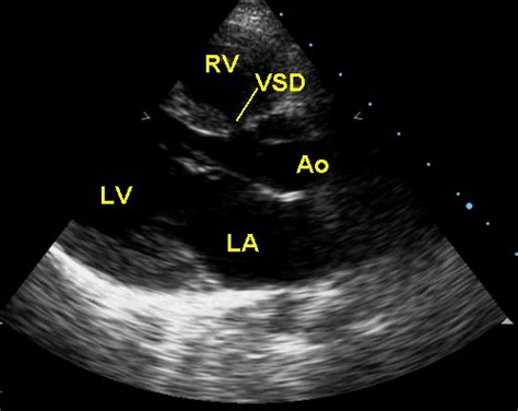 Ventricular septal defect (VSD) – Cardiophile MD