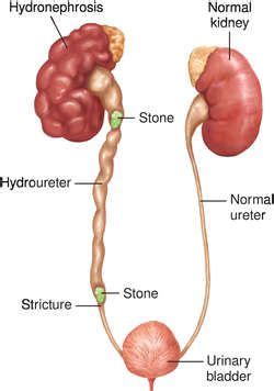 HYDRONEPHROSIS Nursing Study, Nursing Notes, Medical School Interview ...