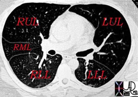 000 Fissures of the Lung | Lungs