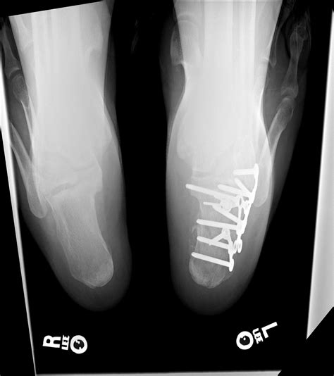 Calcaneus fracture - freeloadstek