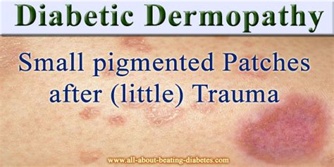 Diabetic dermopathy - a comprehensive review