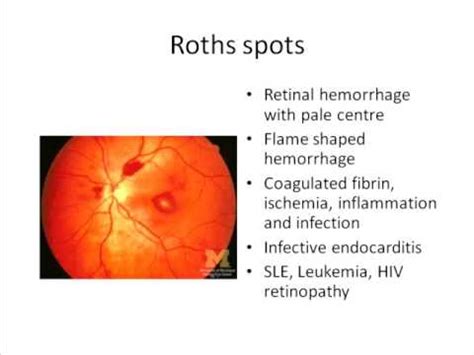 Roth's Spot And Splinter Hemorrhage