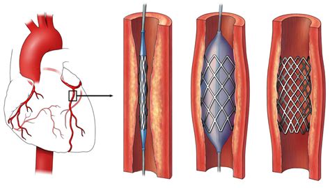 Stents - What to Expect When Getting a Stent | NHLBI, NIH