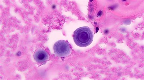 Pathology Outlines - Cryptococcus neoformans & gattii